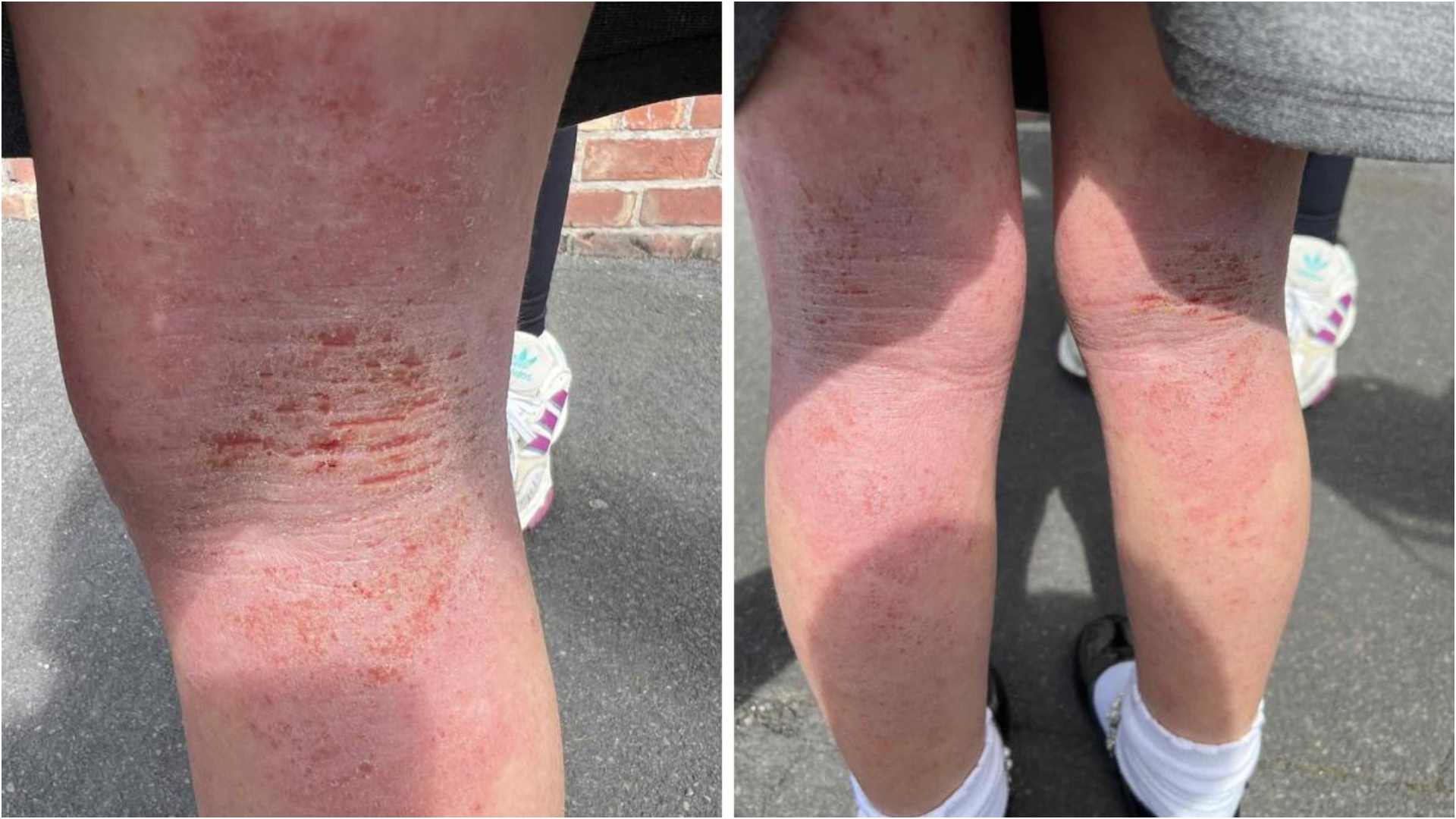 Fetițele suferă de o afecțiune a pielii